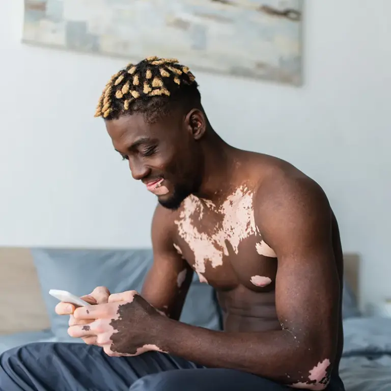 Cahaba Clinical Research - Young man vitiligo