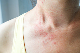 Atopic Dermatitis Clinical Study