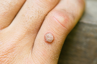 Warts Clinical Trial