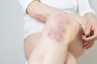 Plaque Psoriasis Clinical Trial