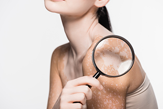 Is There Treatment for Vitiligo?