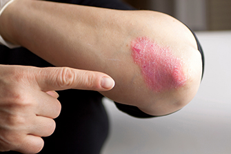 4 Tips to Manage Plaque Psoriasis