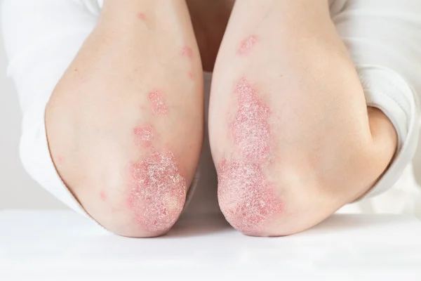 CCR-plaque-psoriasis-1 - Cahaba Clinical Research