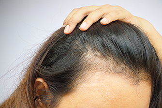 How to Stop Female Hair Loss