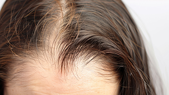 Three Causes of Female Hair Loss