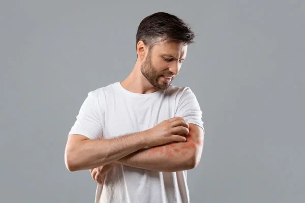 Man in a white t-shirt touching a reddened, itchy-looking patch on his forearm.