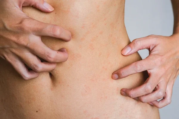 CCR-Eczema-3 CCR-Eczema-3