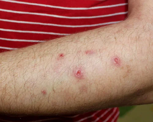 Forearm with several small red circular skin lesions or spots among hair, possibly insect bites or irritated bumps.