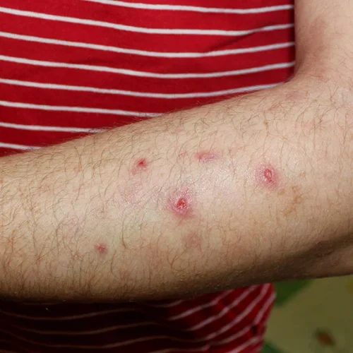 Forearm with several small red circular skin lesions or spots among hair, possibly insect bites or irritated bumps.